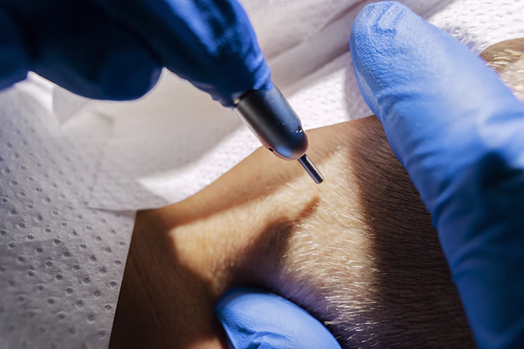 yourmed-servicos-fue-hd-de-alta-densidade-imagem-9